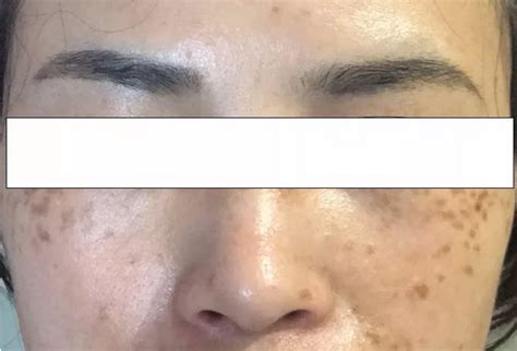 顴骨斑|顴骨母斑（NEVUS ZYGOMATICUS）